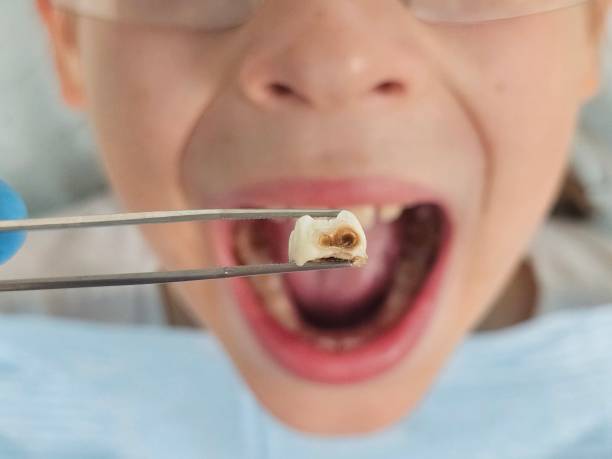 Best Dentist for Tooth Abscess  in Byrdstown, TN
